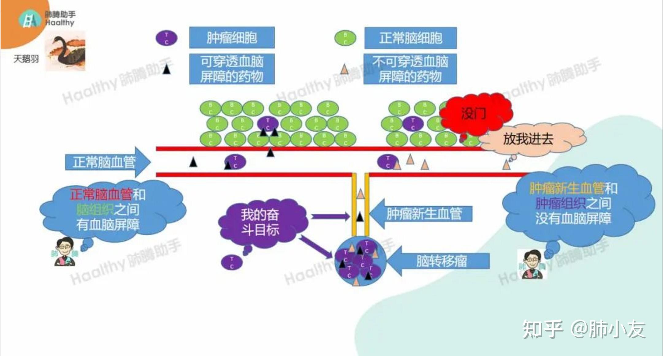 可穿透血脑屏障的纳米颗粒有望用于治疗脑转移肿瘤