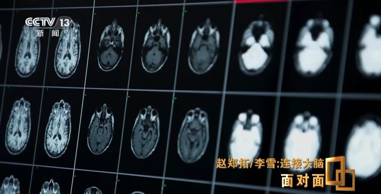 直击脑机接口技术“痛点”，前沿探索正多路并进